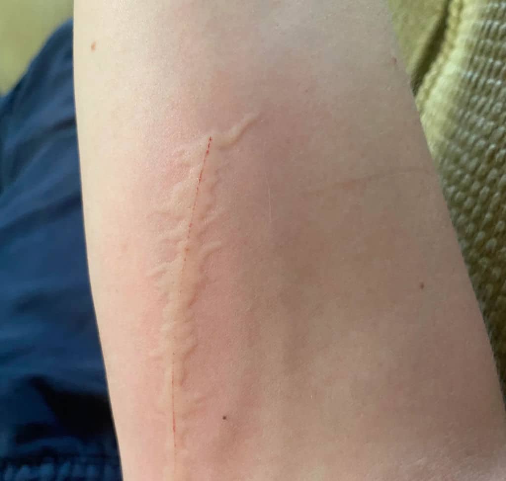 Do Cat Scratches Leave Permanent Scars? (how to remove)