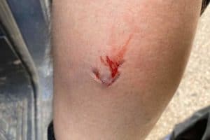 Dog bite on the leg wound