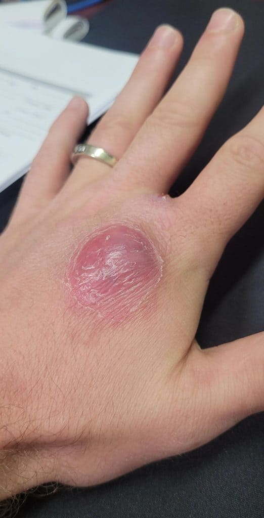 lump under skin after dog bite (infection)