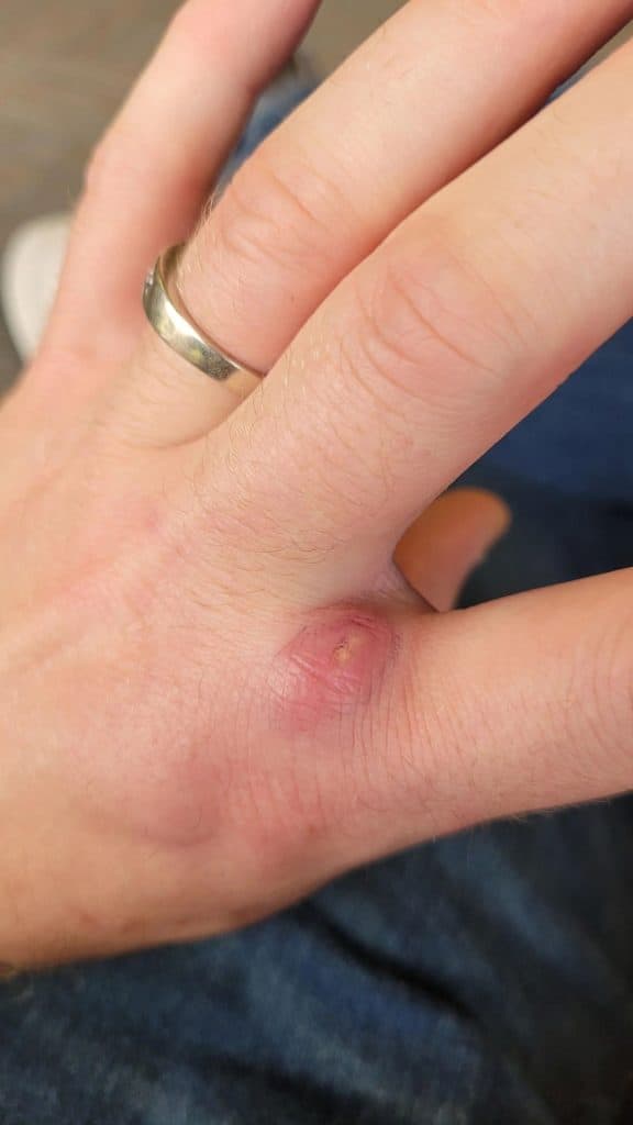 lump under skin after dog bite infection