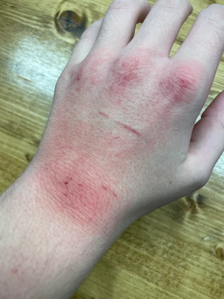 cat scratch fever shown on a hand turning reddish