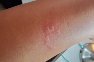 cat scratch on a person's leg